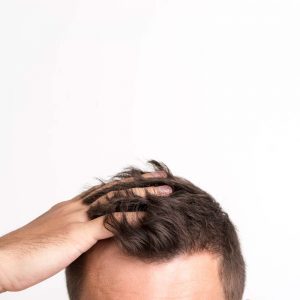 کاشت مو بدون تراشیدن سر