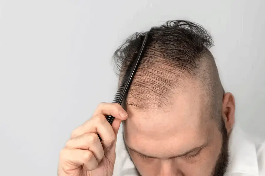 ۱۰ علت ریزش مو در آقایان