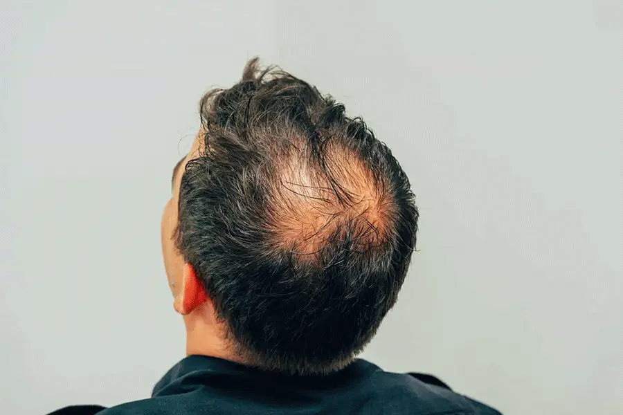 ۱۰ علت ریزش مو در آقایان
