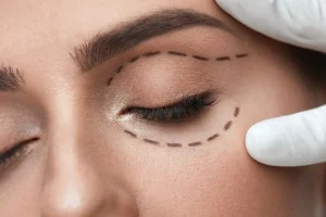 تزریق بوتاکس چشم گربه ای